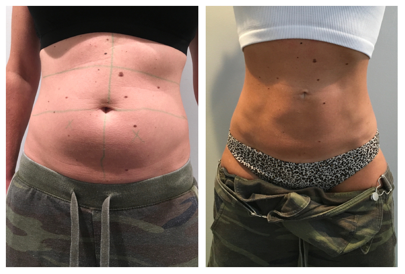 coolsculpting boca raton fl