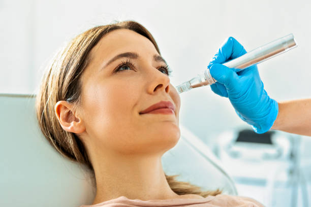 microneedling fort collins