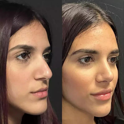 Best Rhinoplasty Surgeon in Dubai: Your Guide to a Successful Procedure