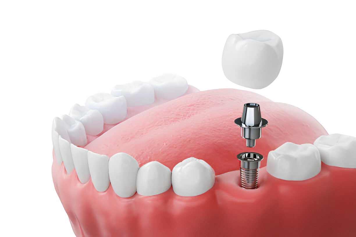 top dental implant specialists in Aberdeen