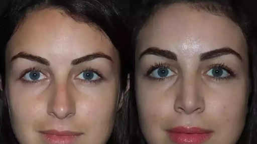 How the Best Doctors in Dubai Use Advanced Technology for Rhinoplasty