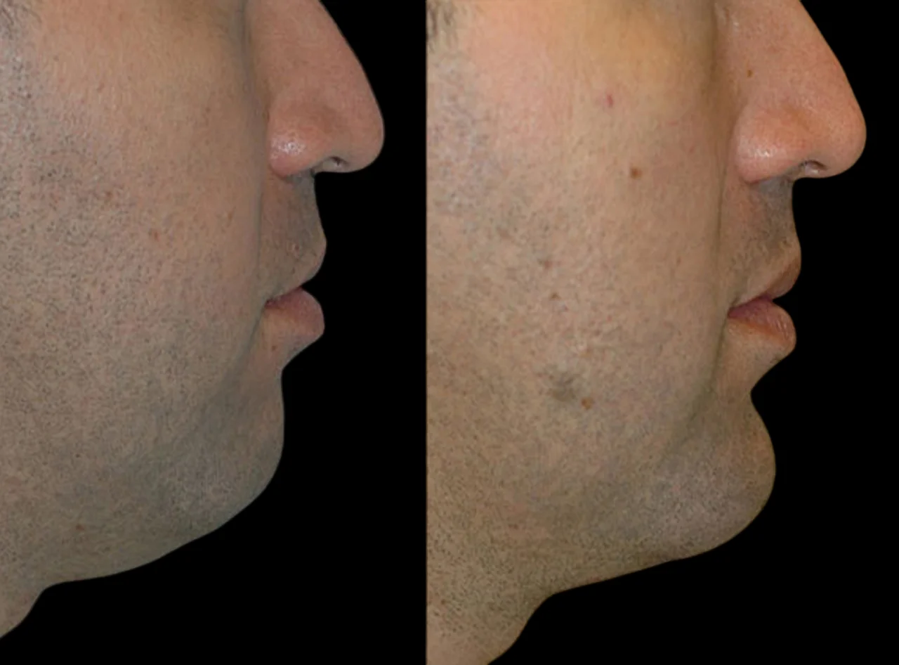 Chin Fillers in dubai