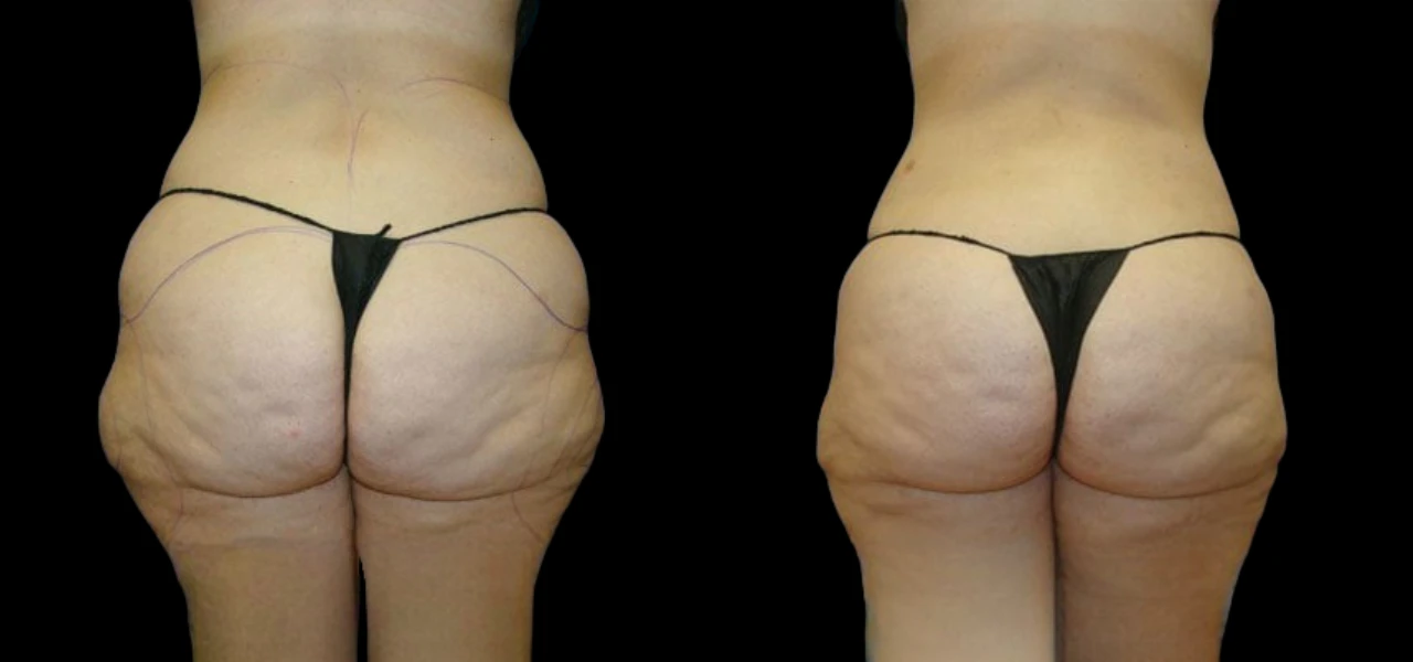 Butt Fat Transfer in Dubai: What to Expect from the Procedure