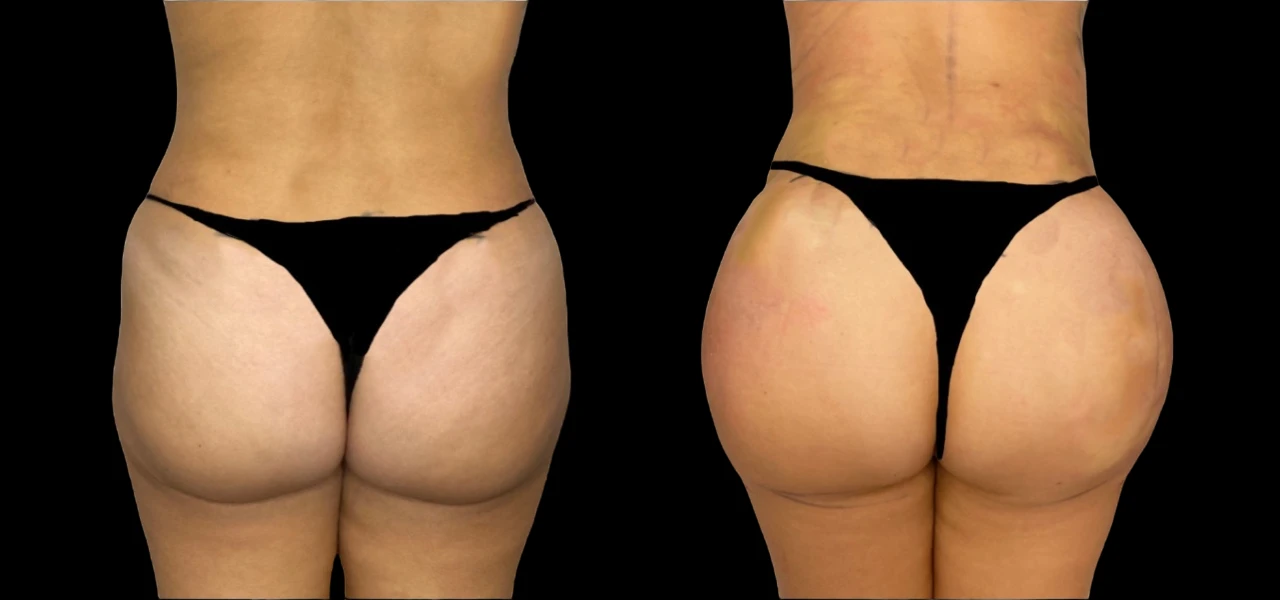 Best Fat Transfer Surgeons in Dubai: How to Maintain Your Results After Surgery