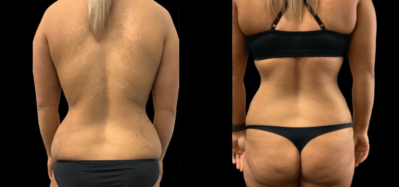 Benefits of Choosing Fat Transfer in Dubai for Natural Enhancement