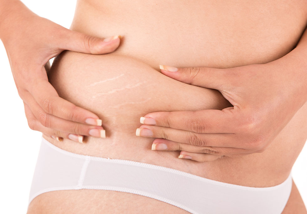 Laser Stretch Mark Removal Doctor in Guwahati