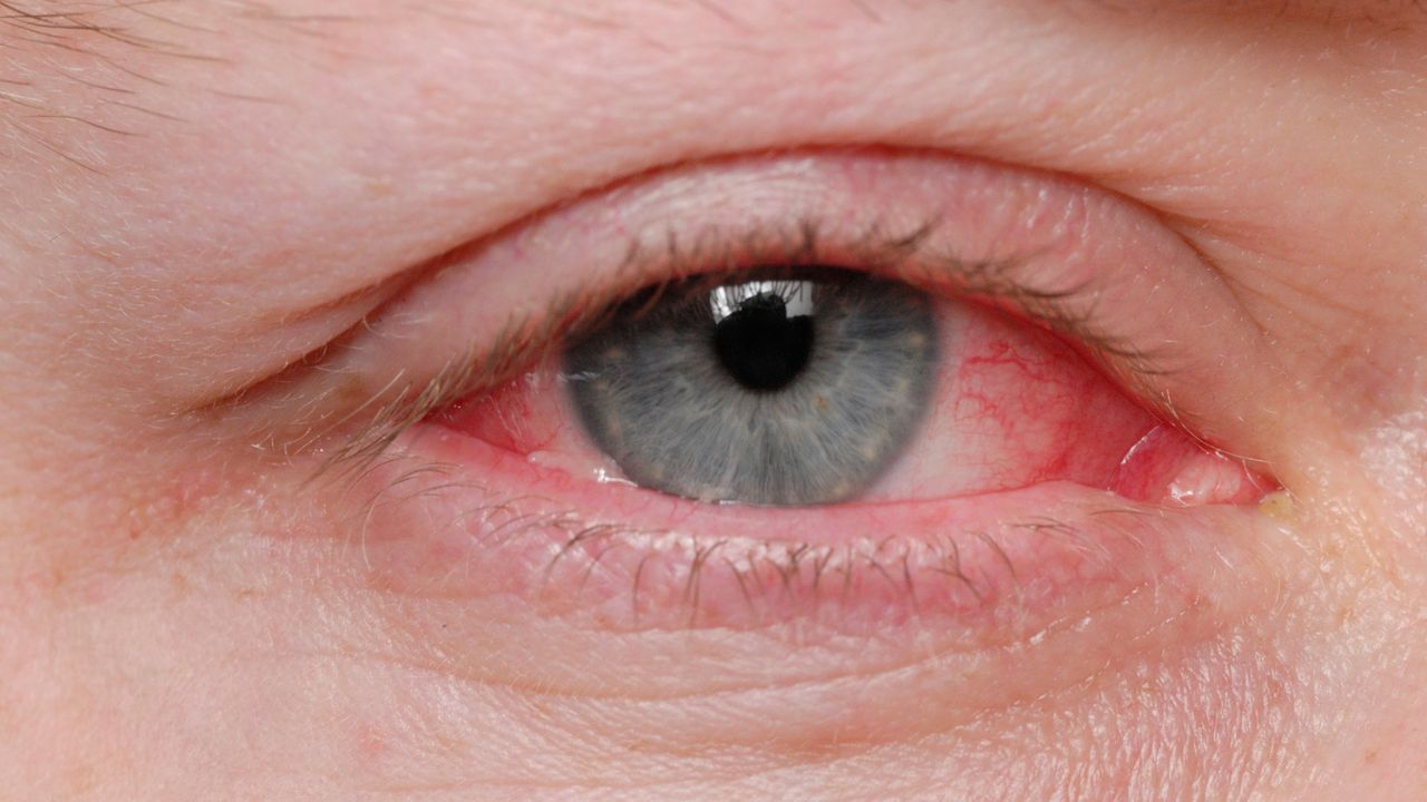 Home Remedies for Conjunctivitis