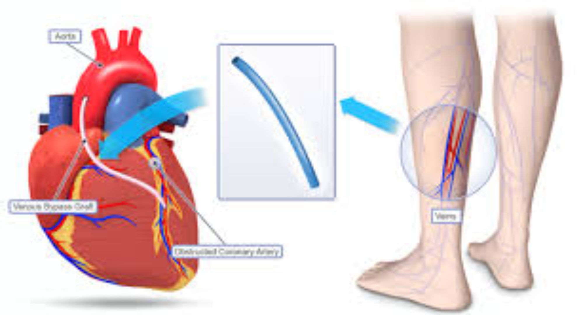 heart bypass images