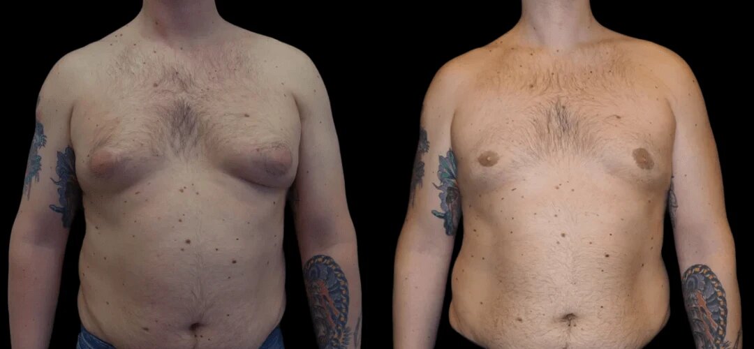 gynecomastia in dubai