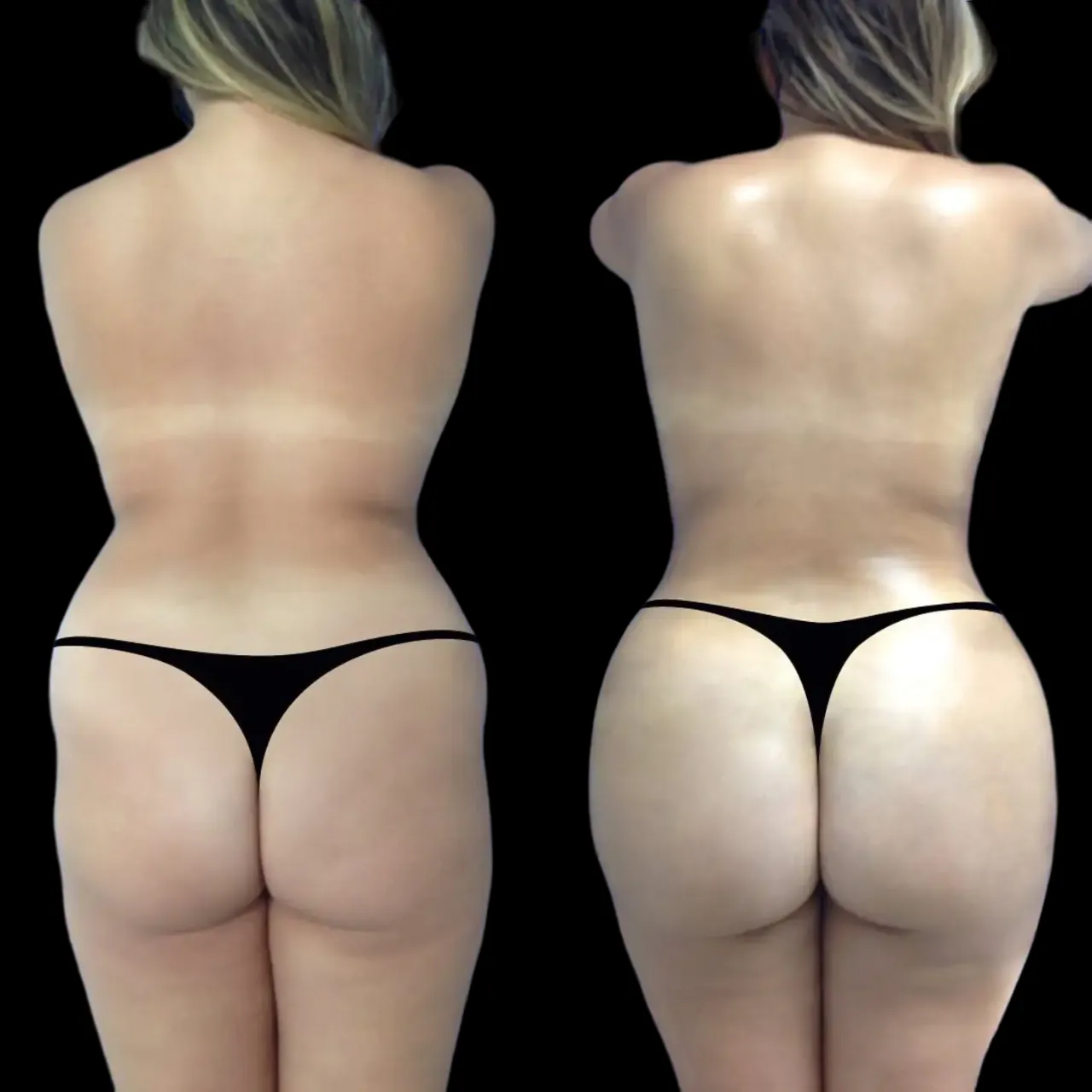 How the Best Butt Fat Transfer Surgeons in Dubai Minimize Risks and Ensure a Smooth Recovery