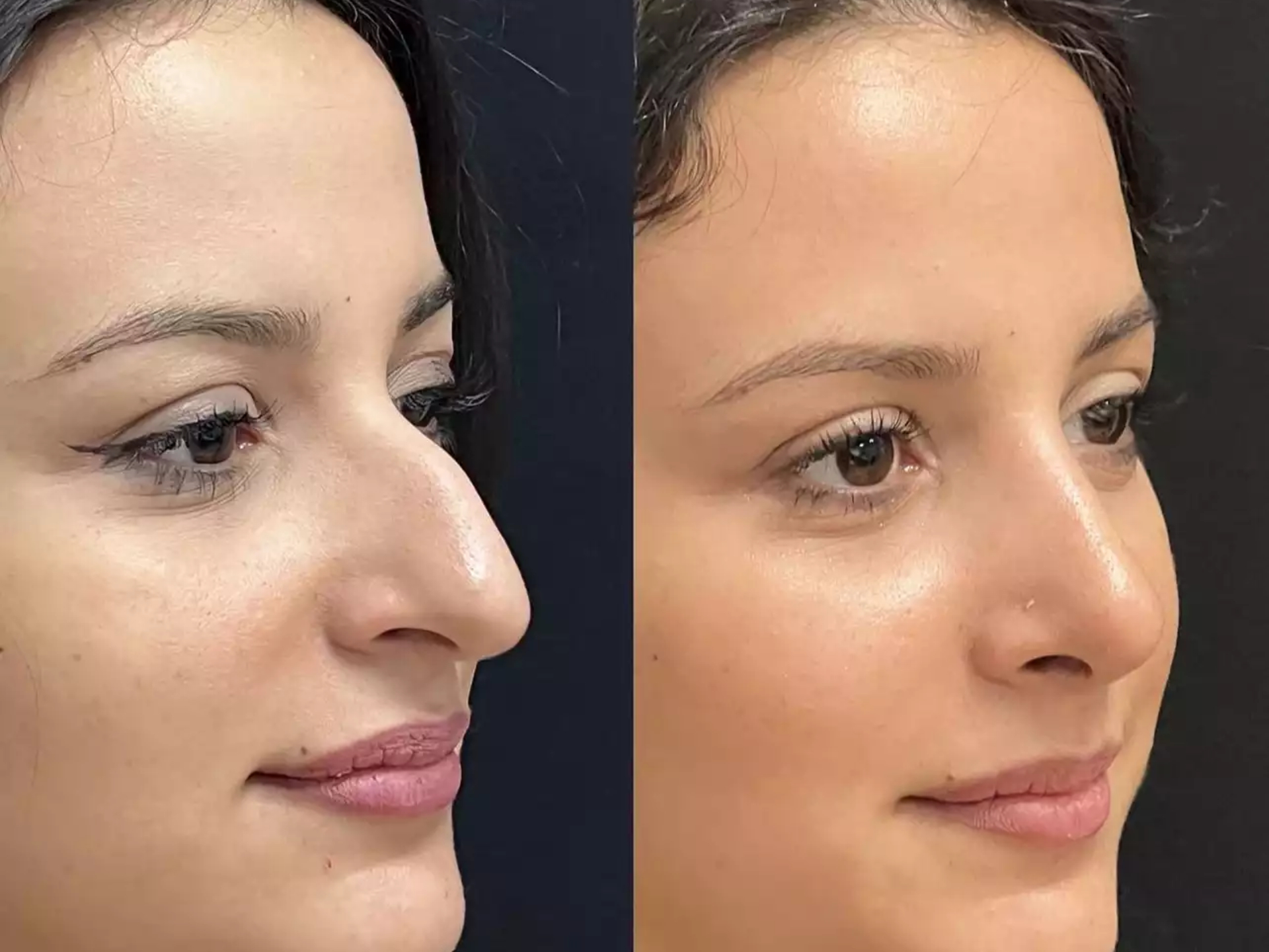 rhinoplasty in dubai
