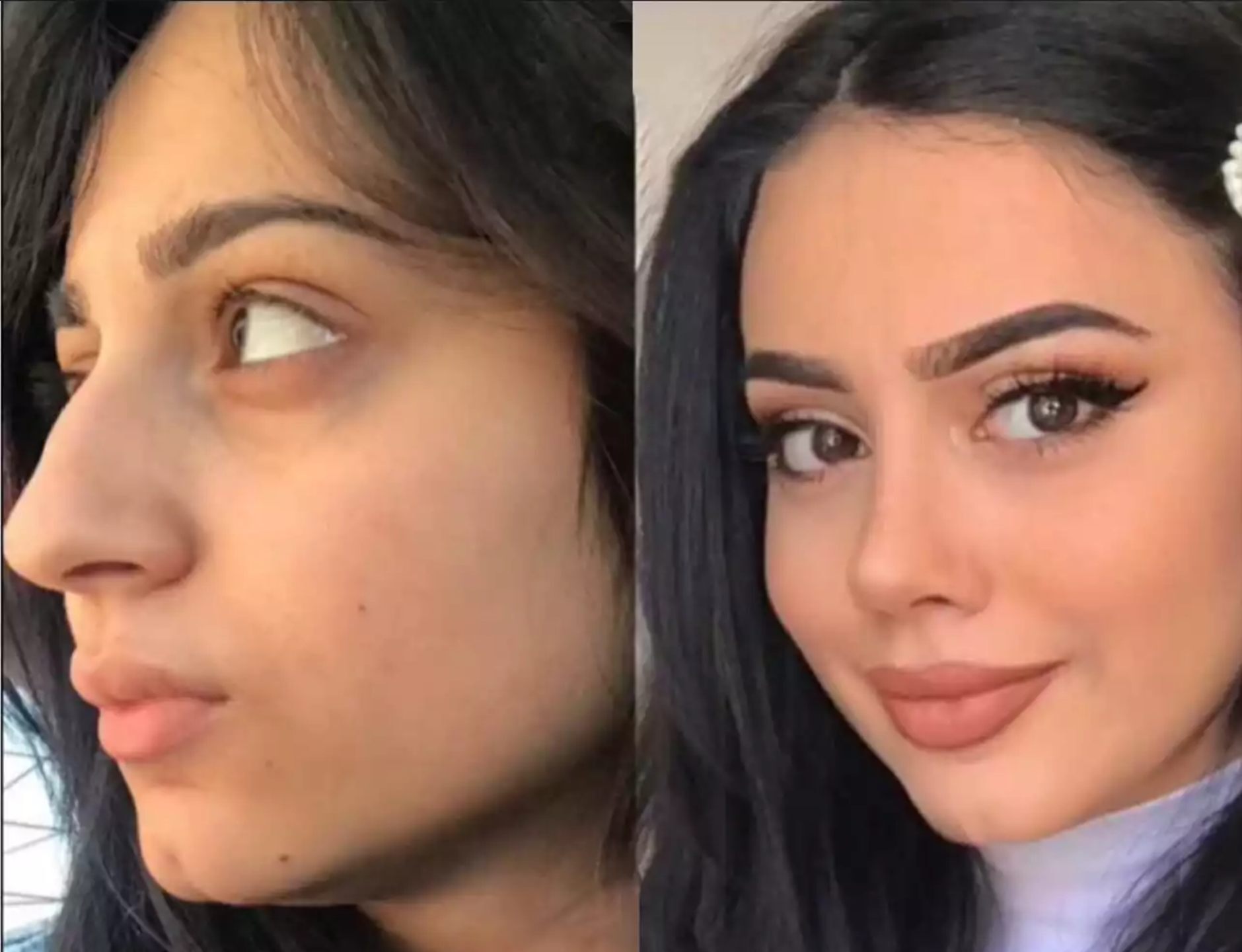 rhinoplasty in Dubai