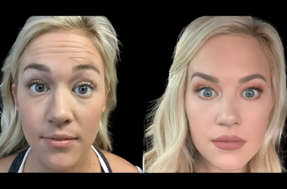 Botox in dubai