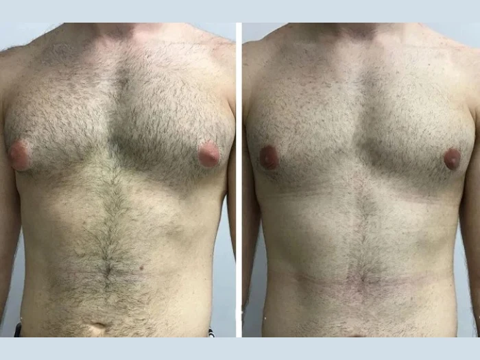 What to Expect from Male Breast Reduction Surgery for Gynecomastia in Dubai