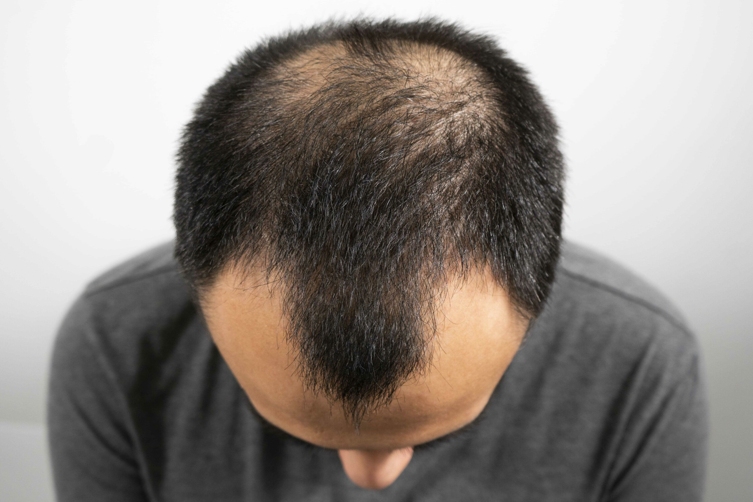 hair transplant clinic birmingham