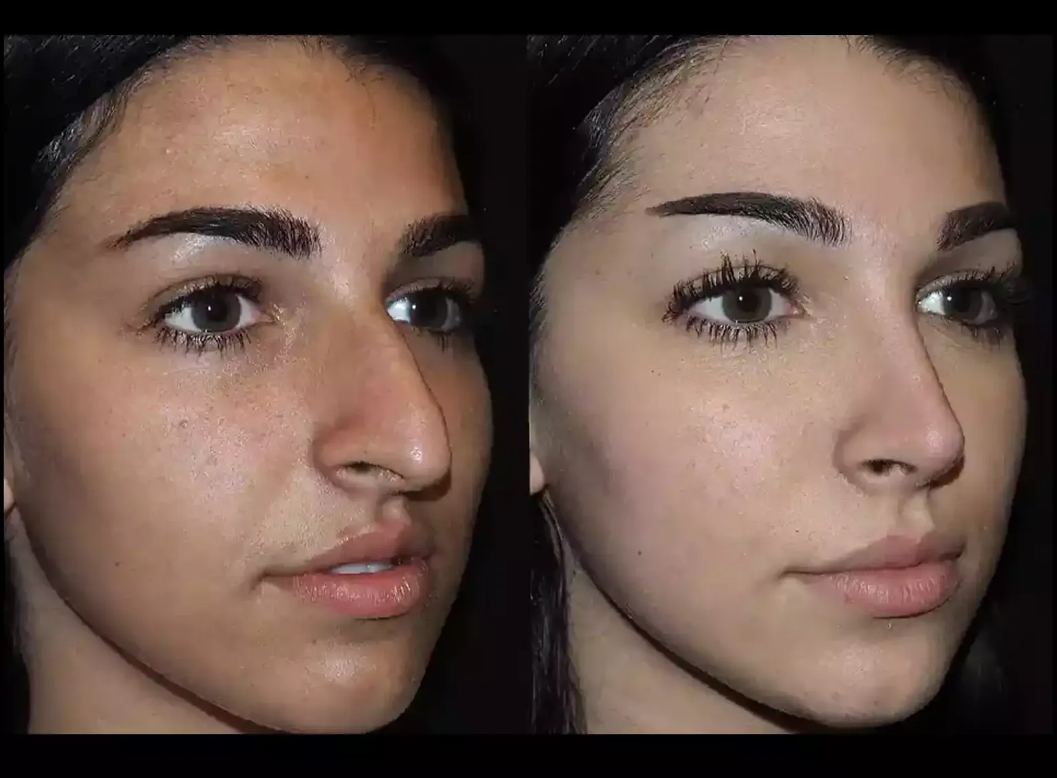 The Best Doctors in Dubai for Rhinoplasty Offer 3D Imaging Planning