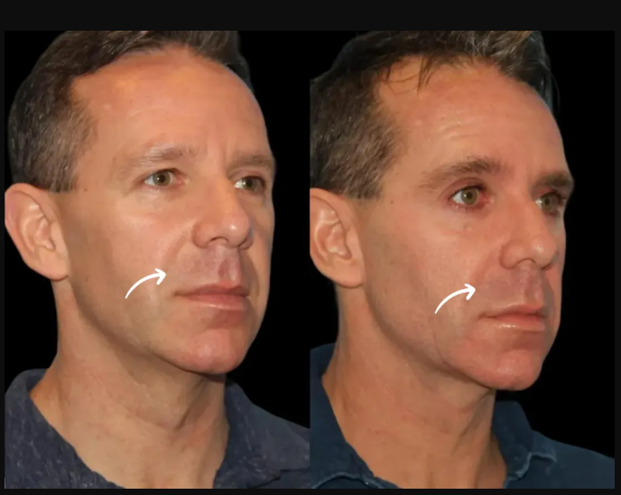 sculptra fillers