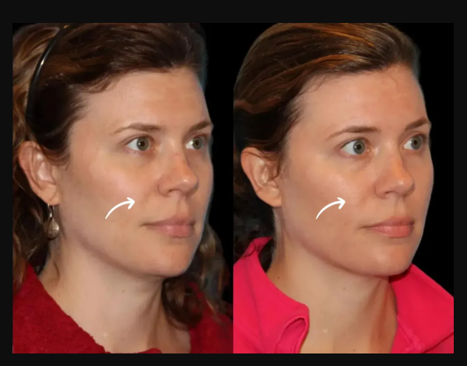 Sculptra Fillers Treatment in Dubai
