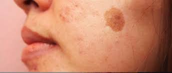 Brown Spot Laser Treatment
