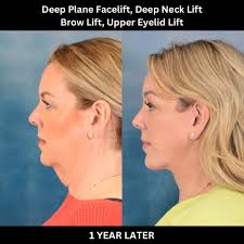 Rejuvenate Your Profile with a Neck Lift in Jeddah