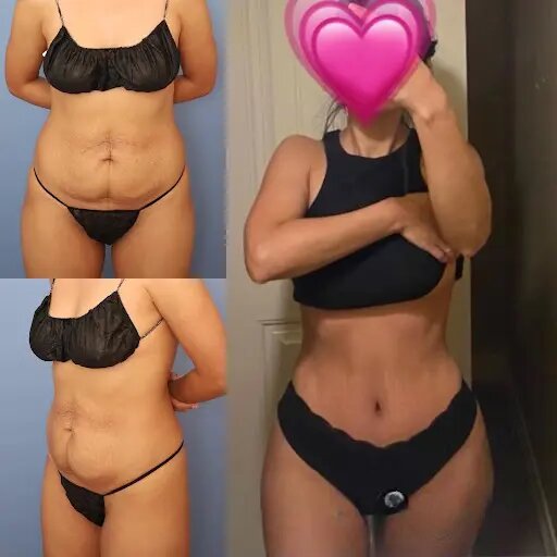 tummy tuck in dubai