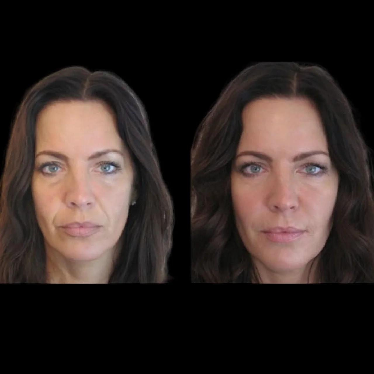 Jawline Fillers Clinic in dubai