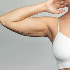 Arm Lift in Jeddah: Say Goodbye to Sagging and Hello to Sculpted Arms