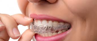 Invisalign Dubai: Comparing It with Traditional Braces for Teeth Alignment