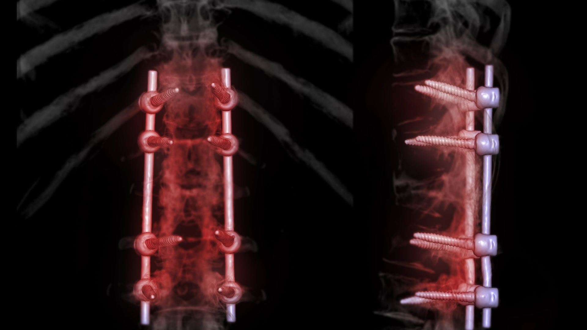 Asia Pacific Spinal Fusion Market