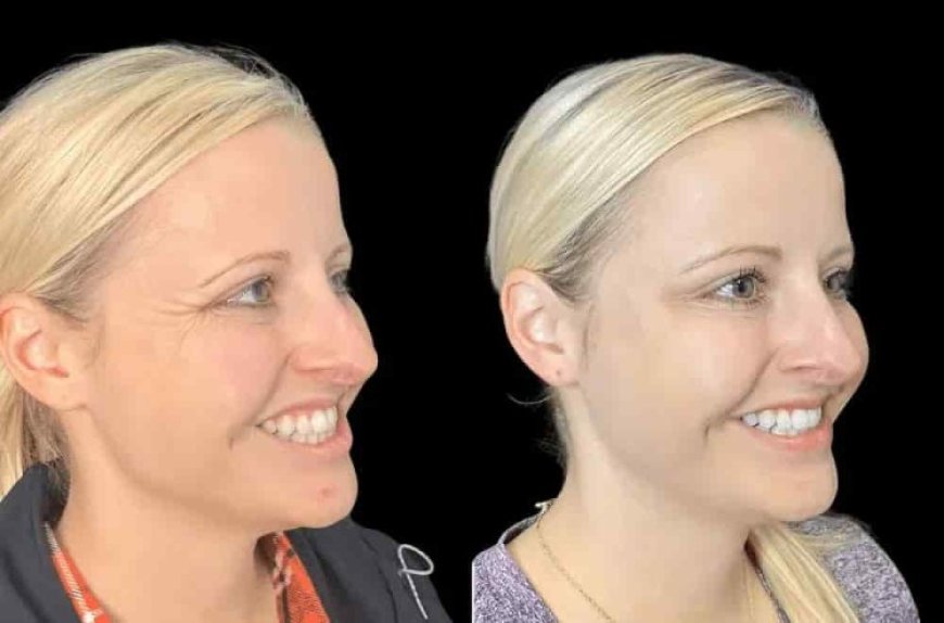 Botox