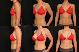 Breast augmentation