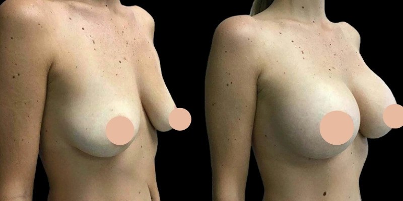 Breast augmentation in dubai
