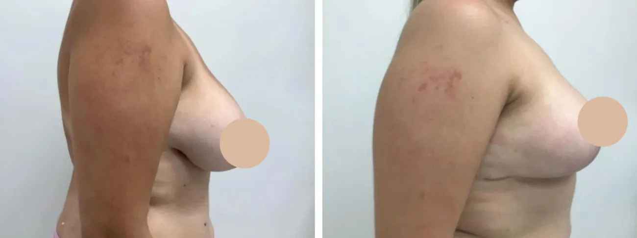 breast reduction in dubai