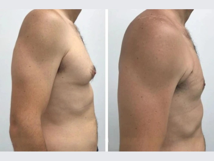 gynecomastia in dubai