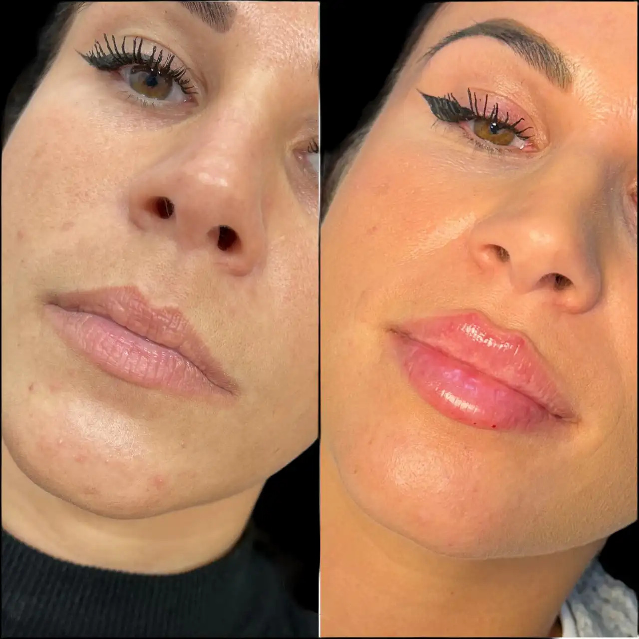 Fillers Clinics in dubai