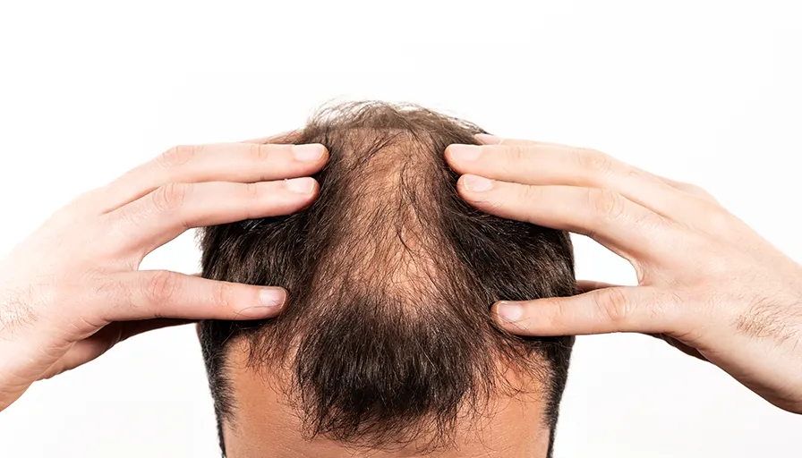 hair fall treatment in Bangalore