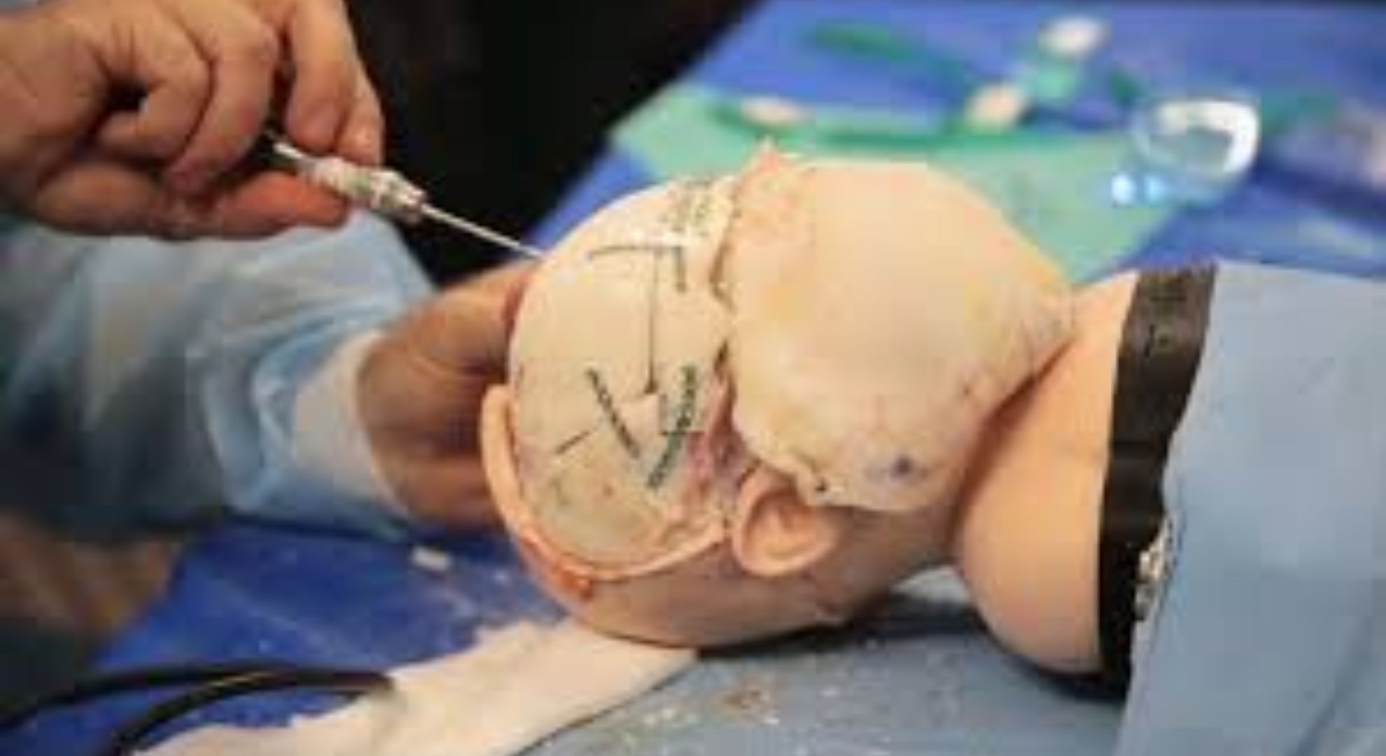 skull surgery image
