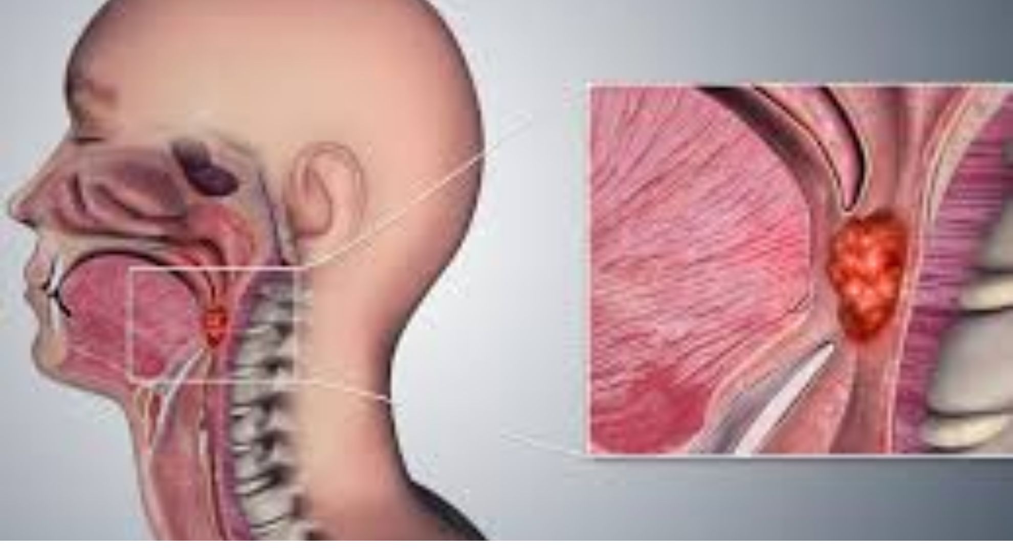 throat cancer image