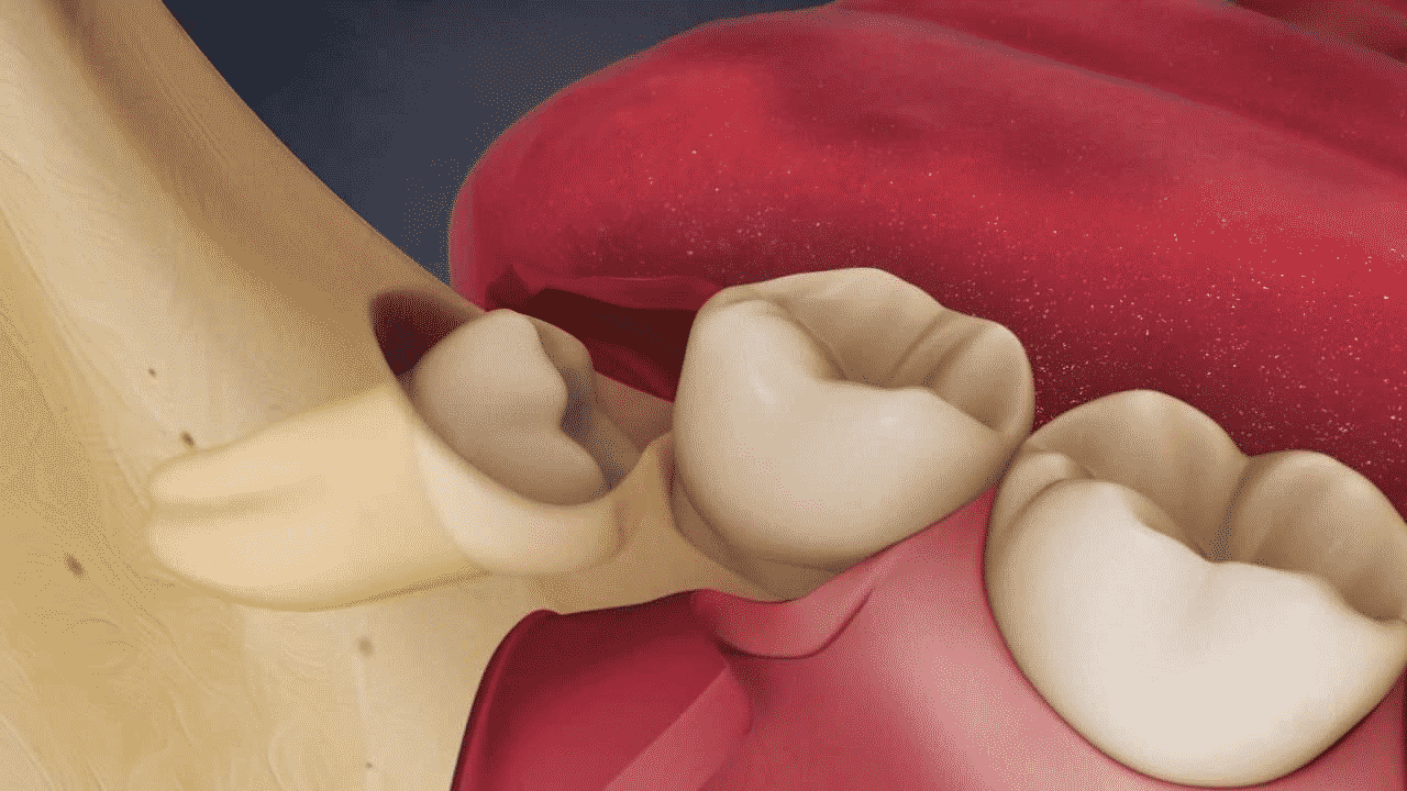 wisdom teeth removal in Nottingham