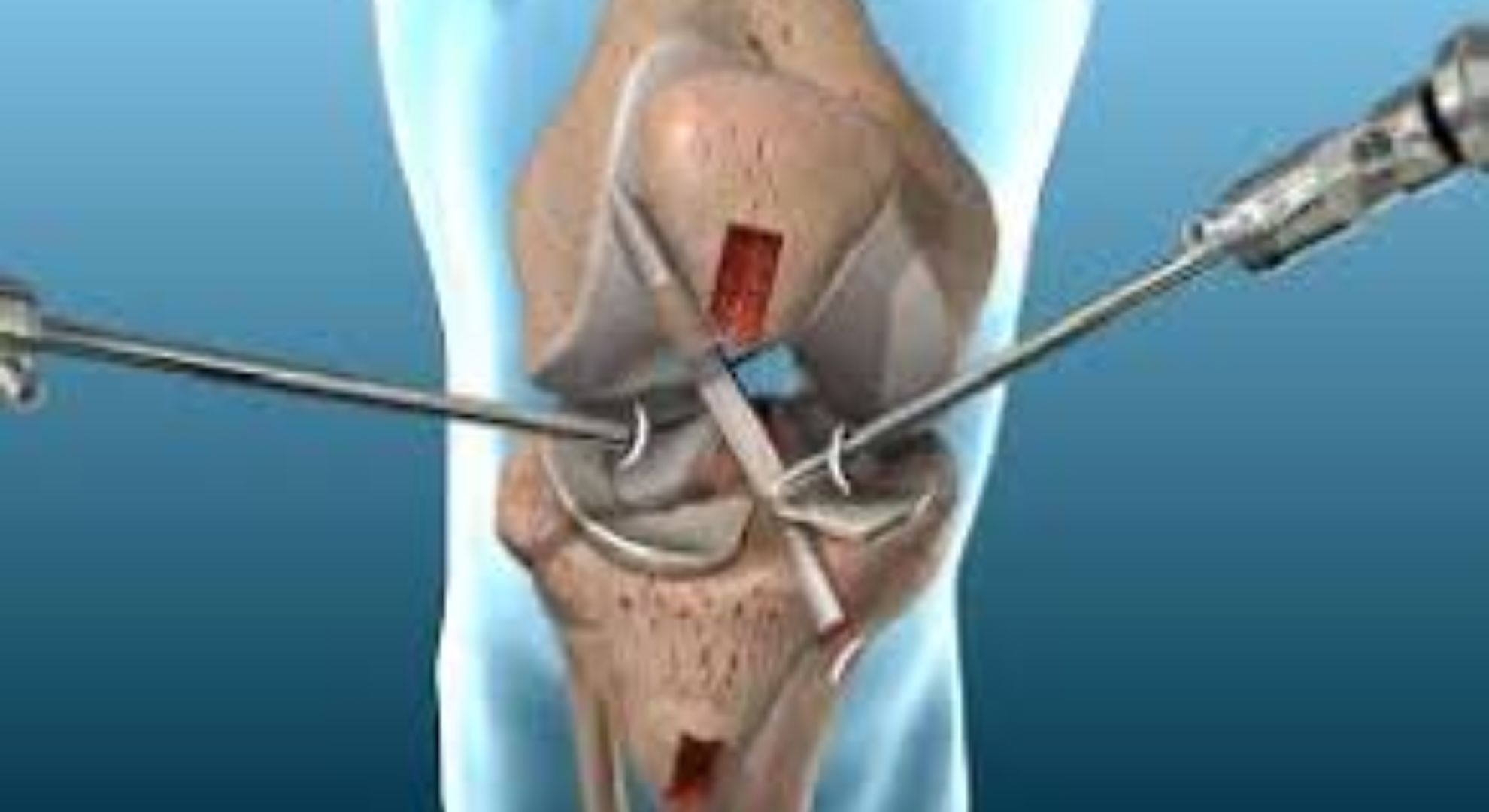 Arthroscopy Surgery image