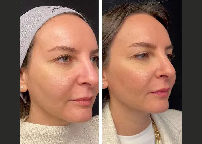 Mesotherapy