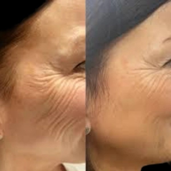 Profhilo treatments in dubai