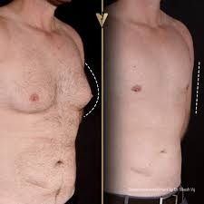 Gynecomastia in Dubai