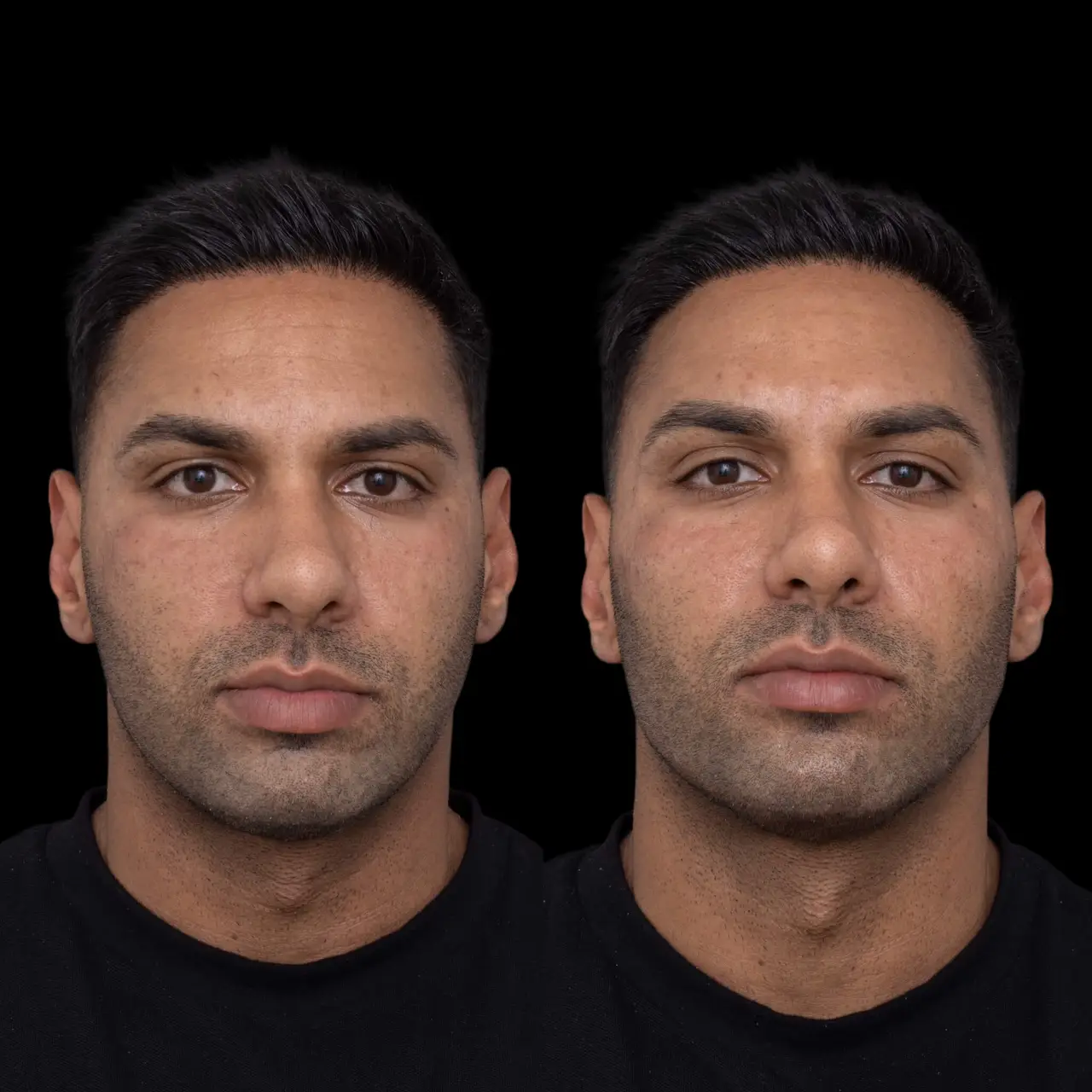 Jawline Fillers