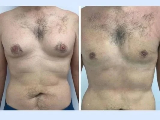 gynecomastia-in-dubai