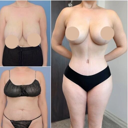 tummy tuck in Dubai