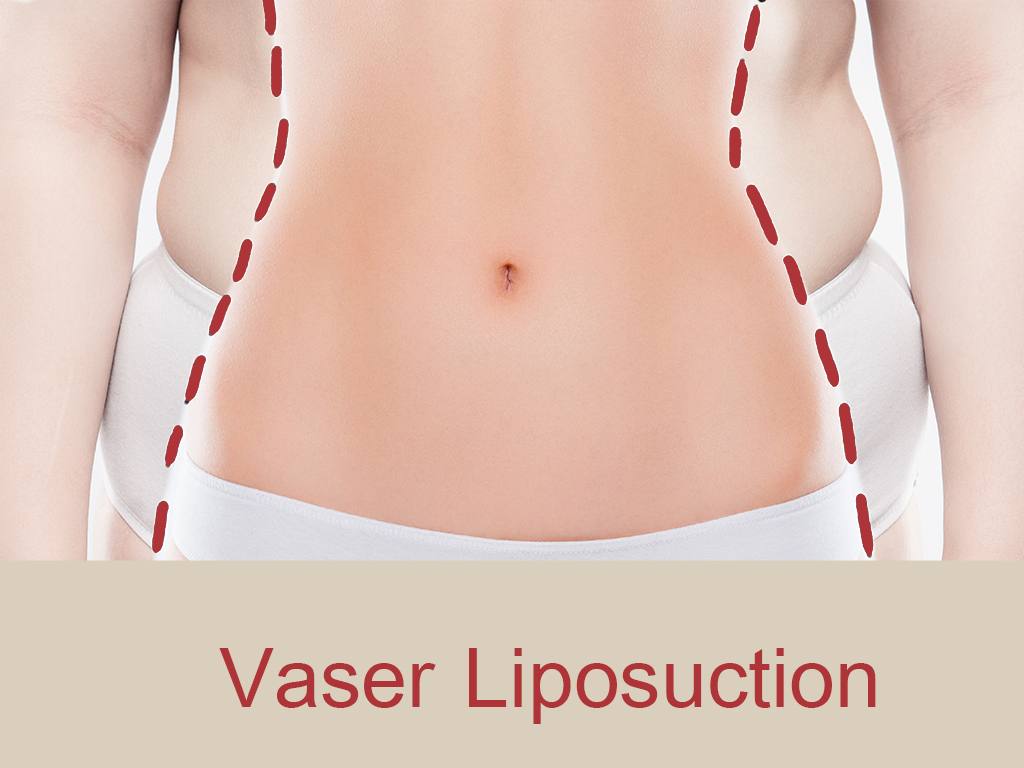 Liposuction in Dubai