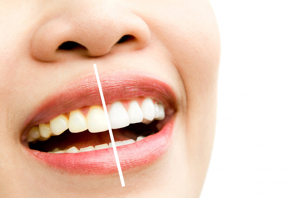 veneer treatment