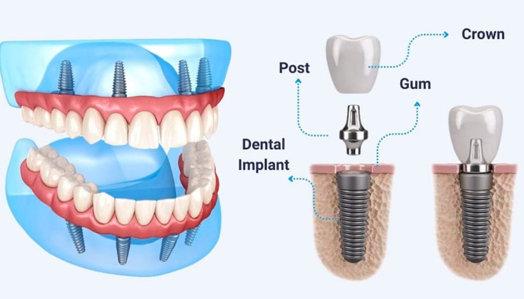 Understand dental implants glendale