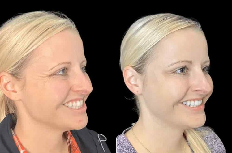 Botox in Dubai for Forehead Lines and Crow’s Feet